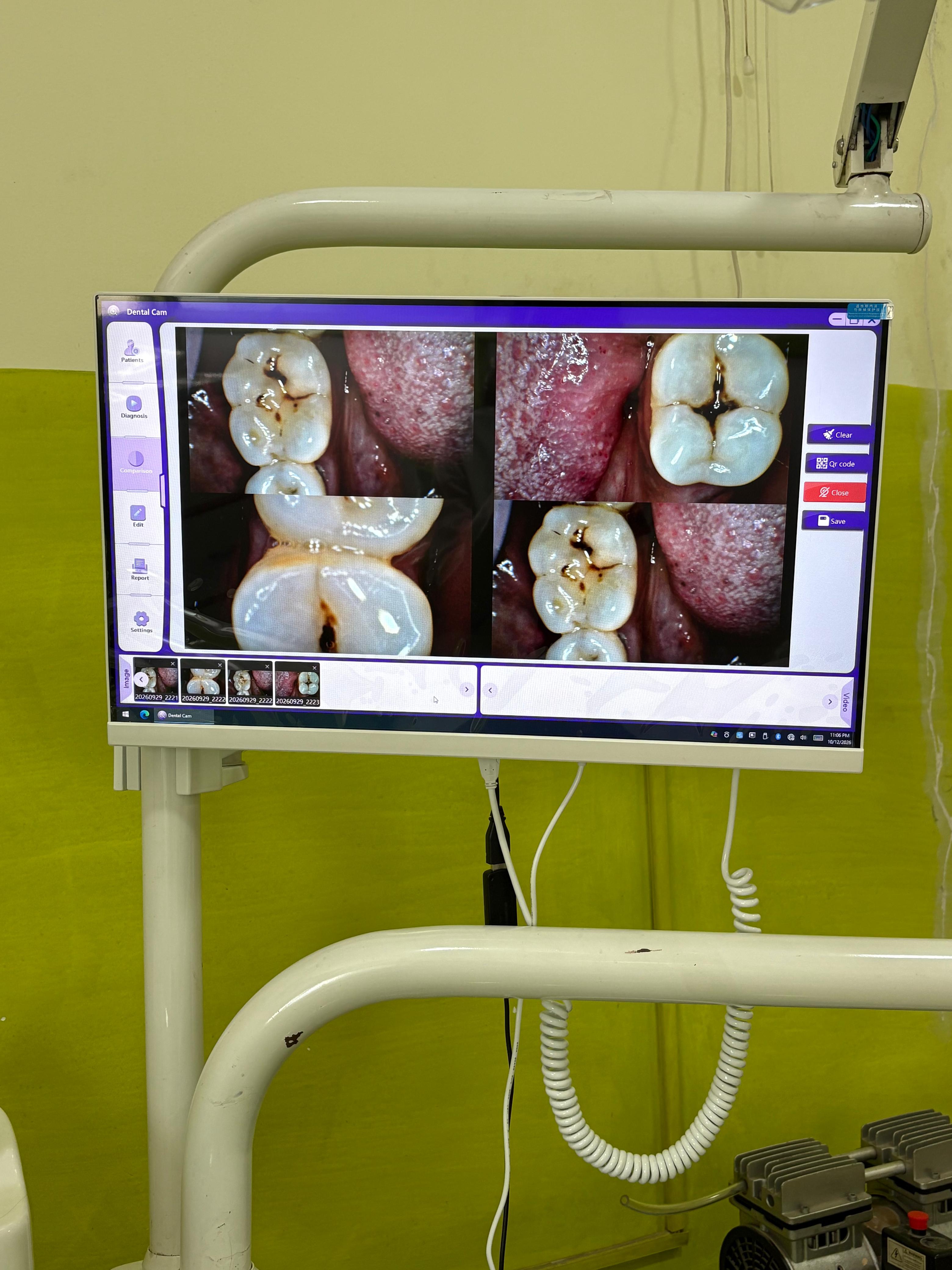Intraoral camera images of teeth displayed on a monitor at the dental clinic