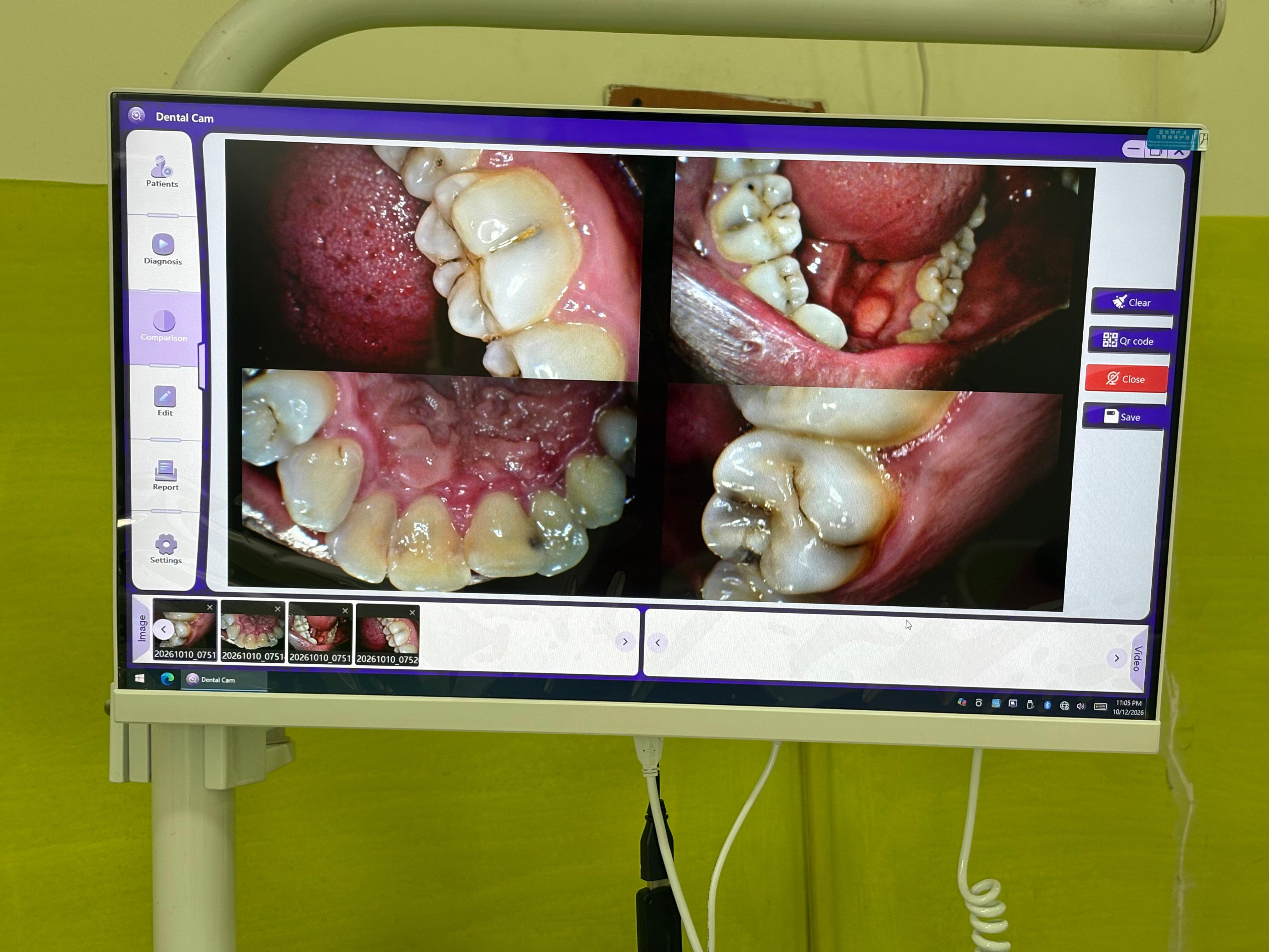 Close-up intraoral dental images displayed on the clinic monitor
